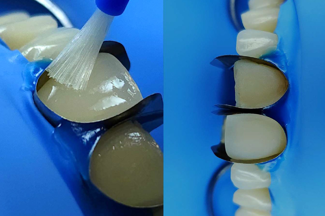 style italiano styleitaliano Teeth preparation, rubber dam and matrix placement, and bonding procedure