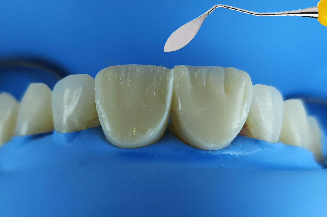 style italiano styleitaliano Dentin and mamelons layering