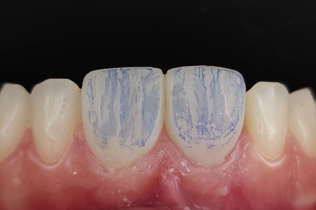 style italiano styleitaliano Rubbing an articulating paper on the buccal surface