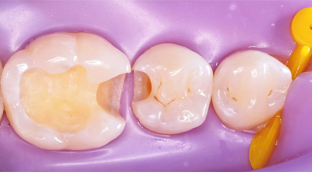 style italiano styleitaliano Isolation and cavity preparation