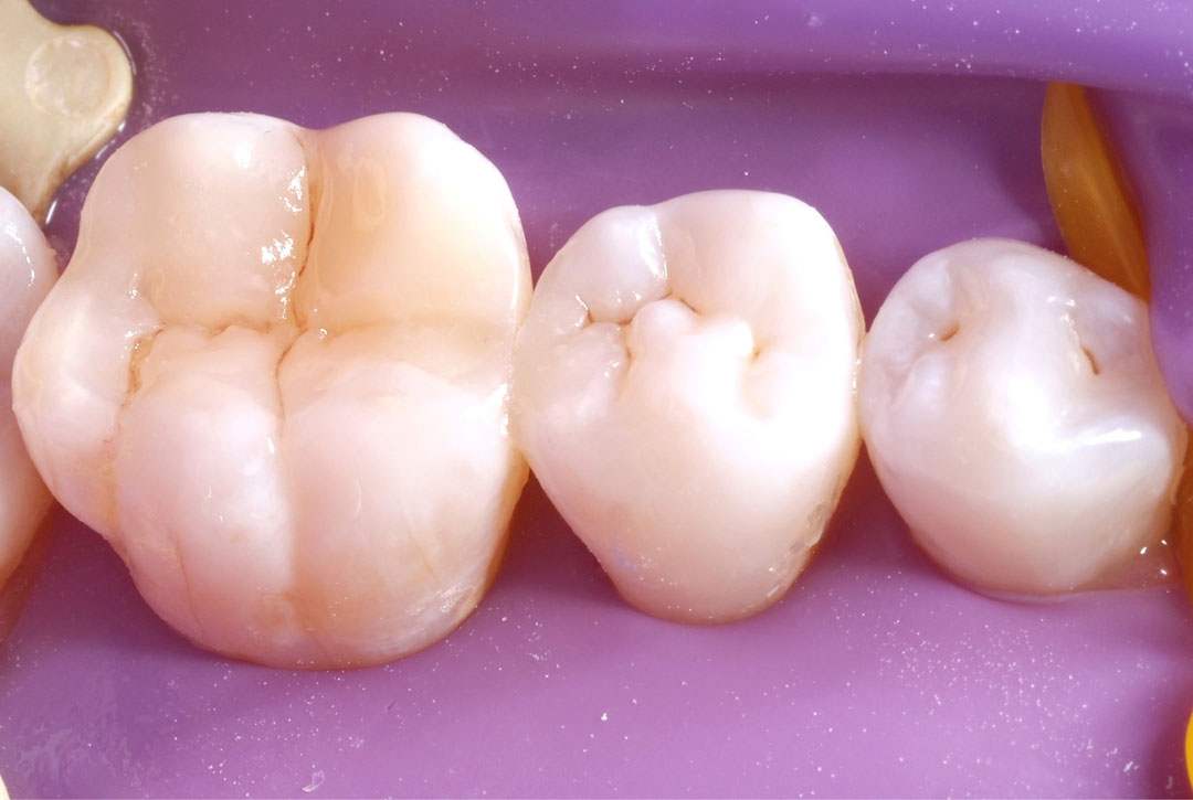 style italiano styleitaliano class 2 composite restoration final situation