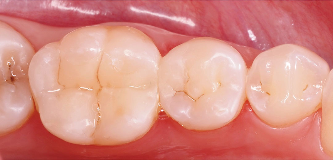 style italiano styleitaliano after 1 month of composite restorations