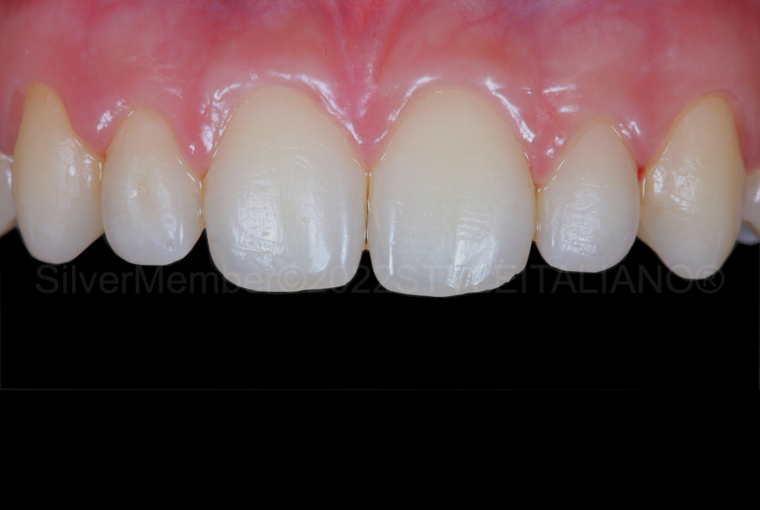 styleitaliano style italiano initial situation with oval shaped teeth