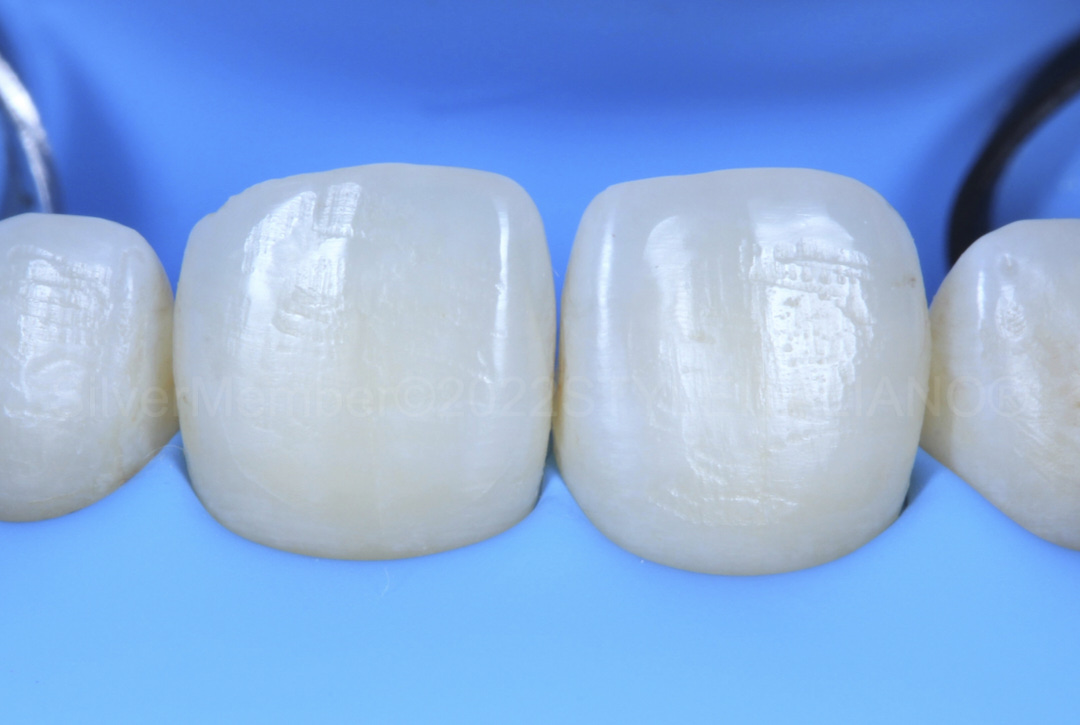 styleitaliano style italiano incisors isolated with rubber dam