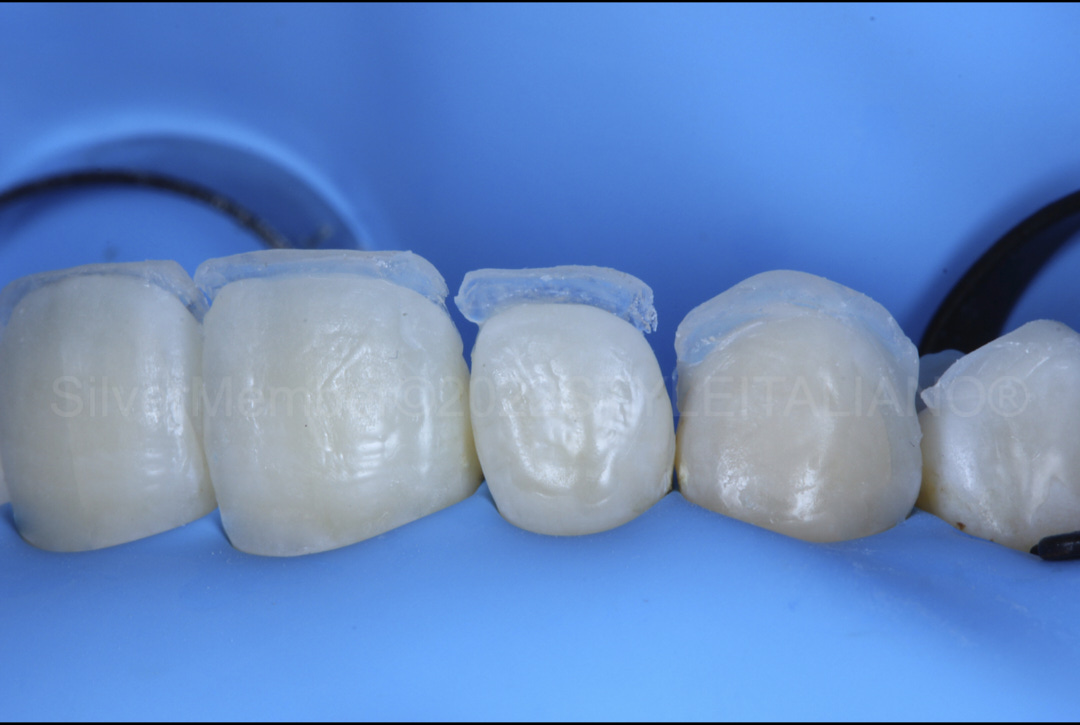 styleitaliano style italiano palatal composite shells before proximal build up