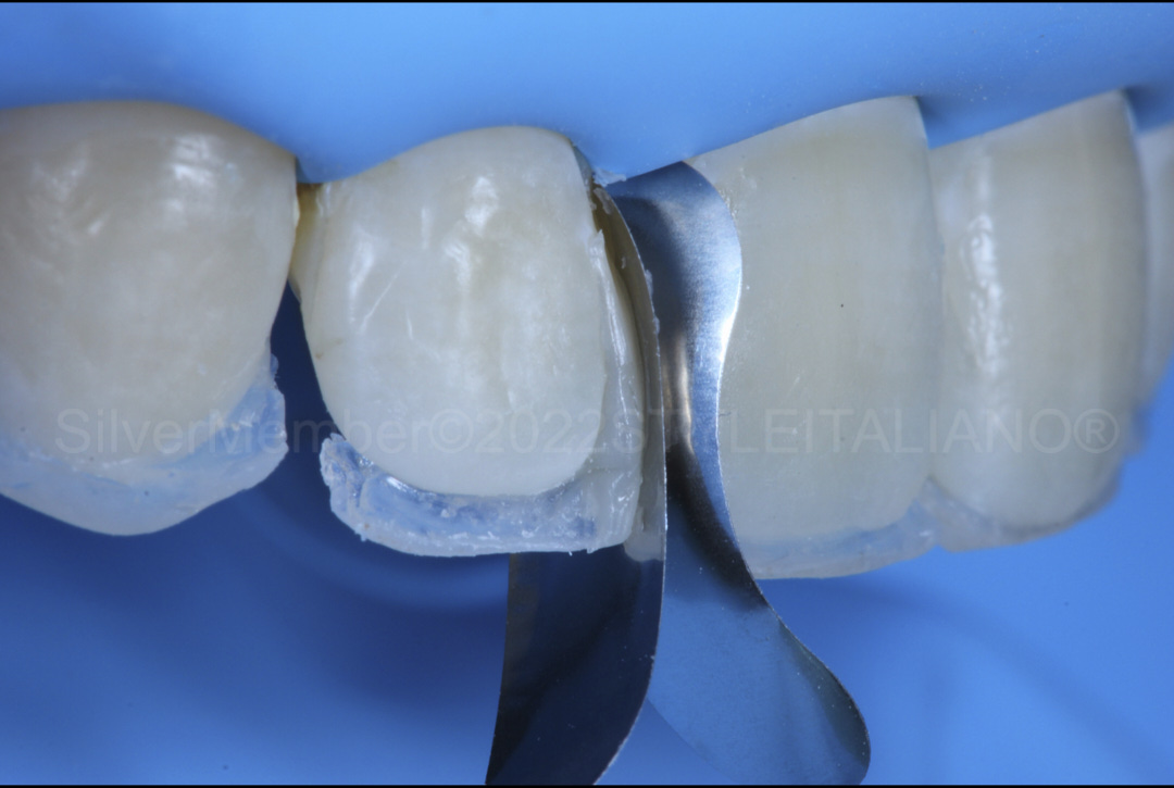 styleitaliano style italiano contouring with matrices for direct composite veneering