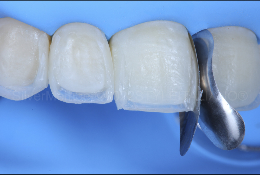 styleitaliano style italiano contoured teeth during composite veneering