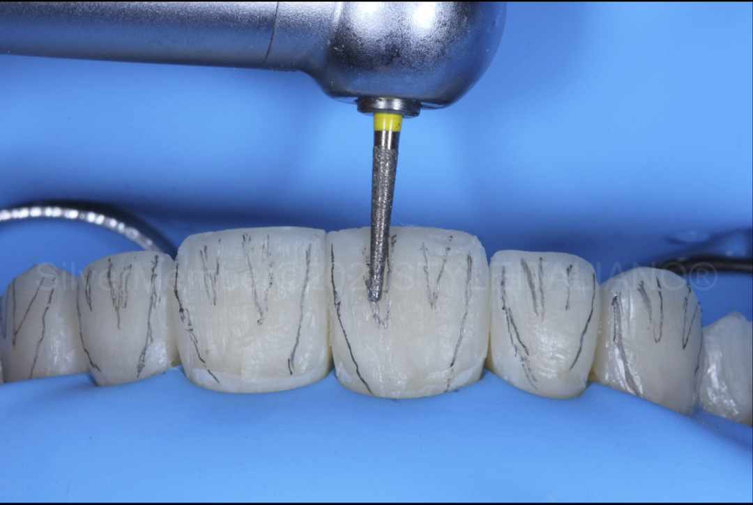 styleitaliano style italiano fine grit but creating surface anatomy in composite veneers