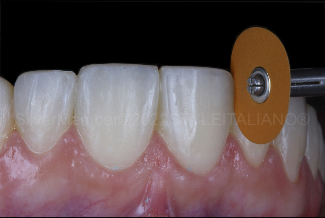 styleitaliano style italiano medium grit disc prepolishing composite veneers