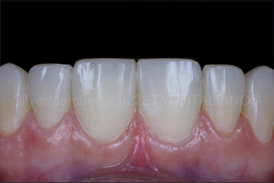 styleitaliano style italiano polished direct dental composite veneers