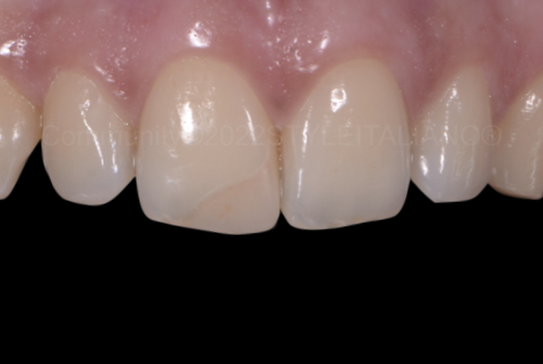 styleitaliano style italiano incisor with old composite restoration