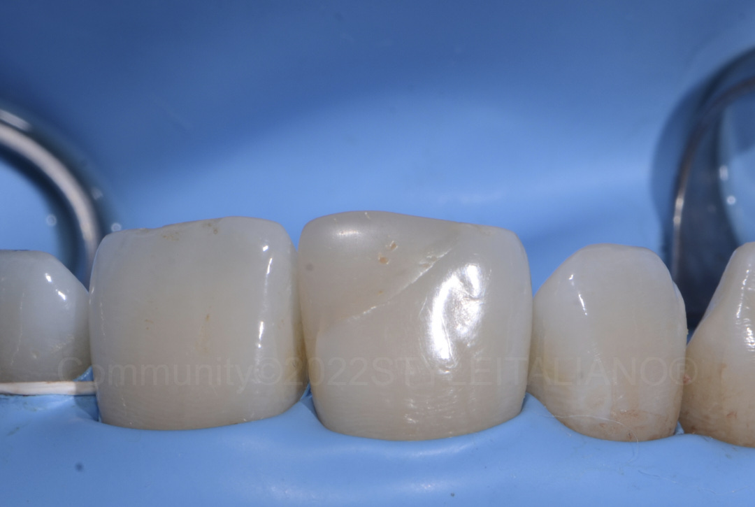 styleitaliano style italiano isolation with rubber dam before removal of old composite