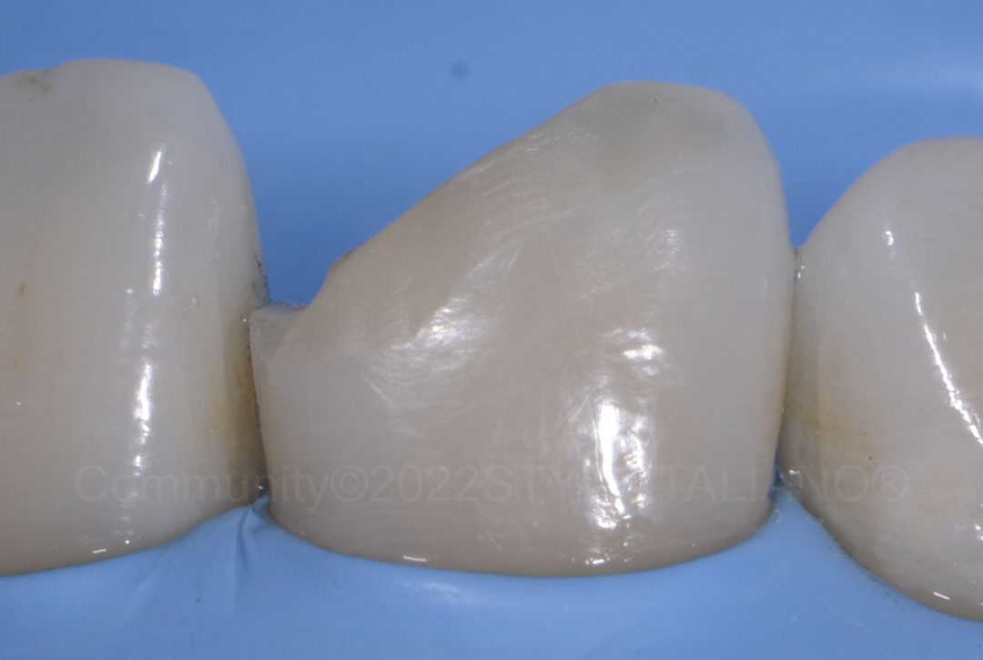styleitaliano style italiano class IV prepared cavity