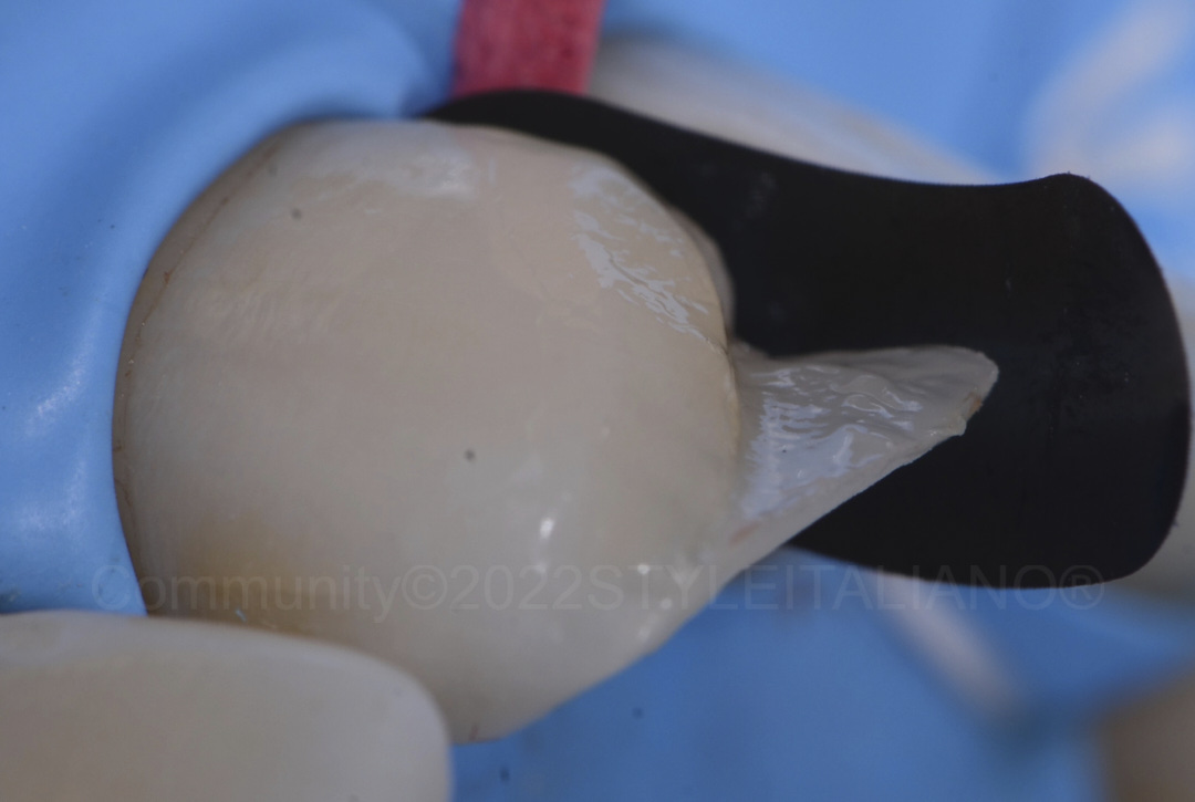 styleitaliano style italiano built palatal shell for class IV composite restoration