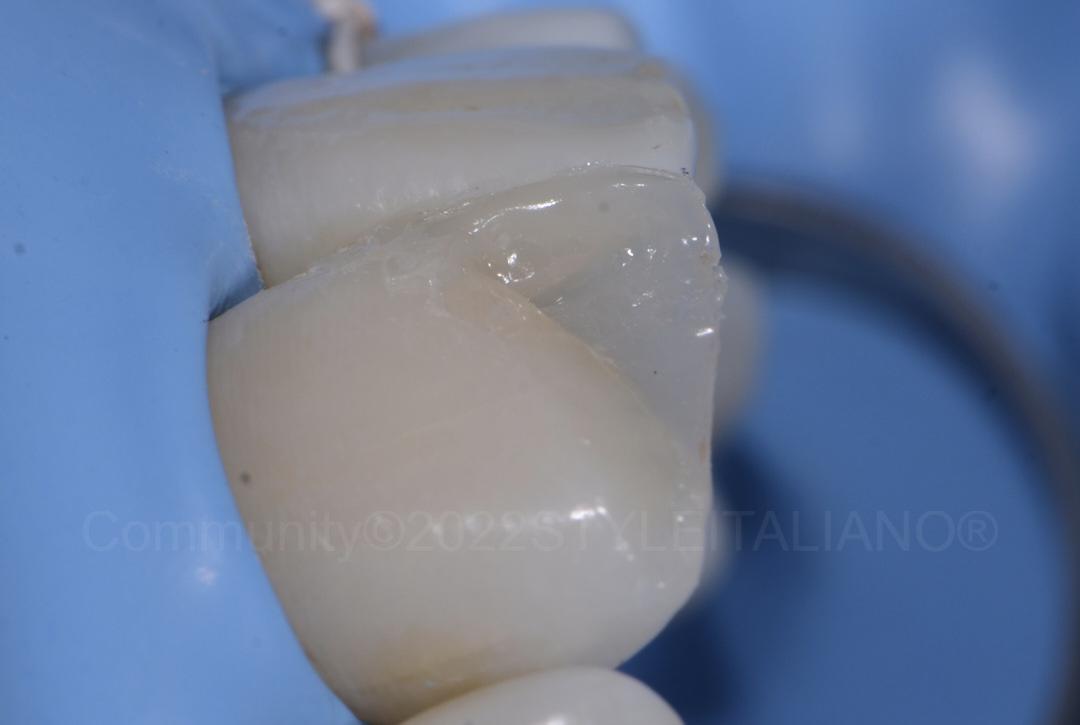 styleitaliano style italiano palatal and proximal restoration of incisor