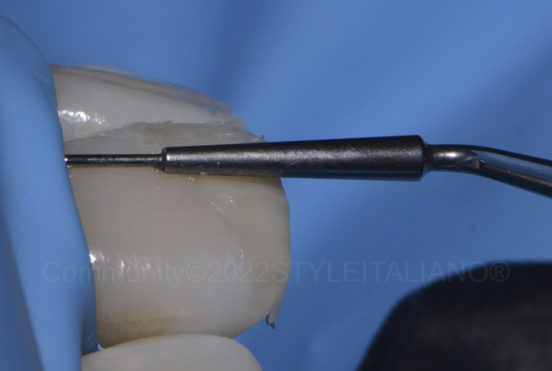 styleitaliano style italiano calibrating composite shade thickness with dedicated instrument