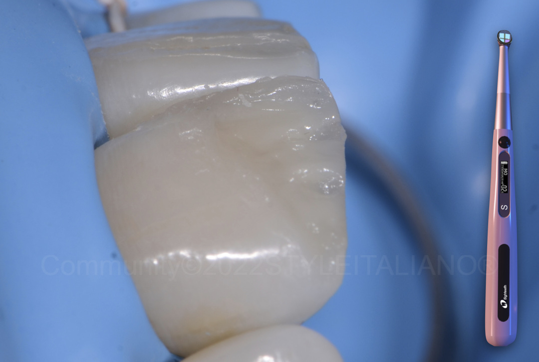 styleitaliano style italiano dental restoration ready to receive final enamel layer