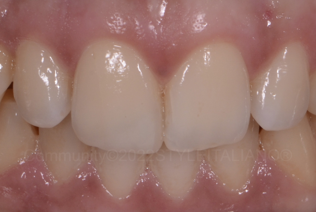 styleitaliano style italiano final aspect of incisor composite restoration