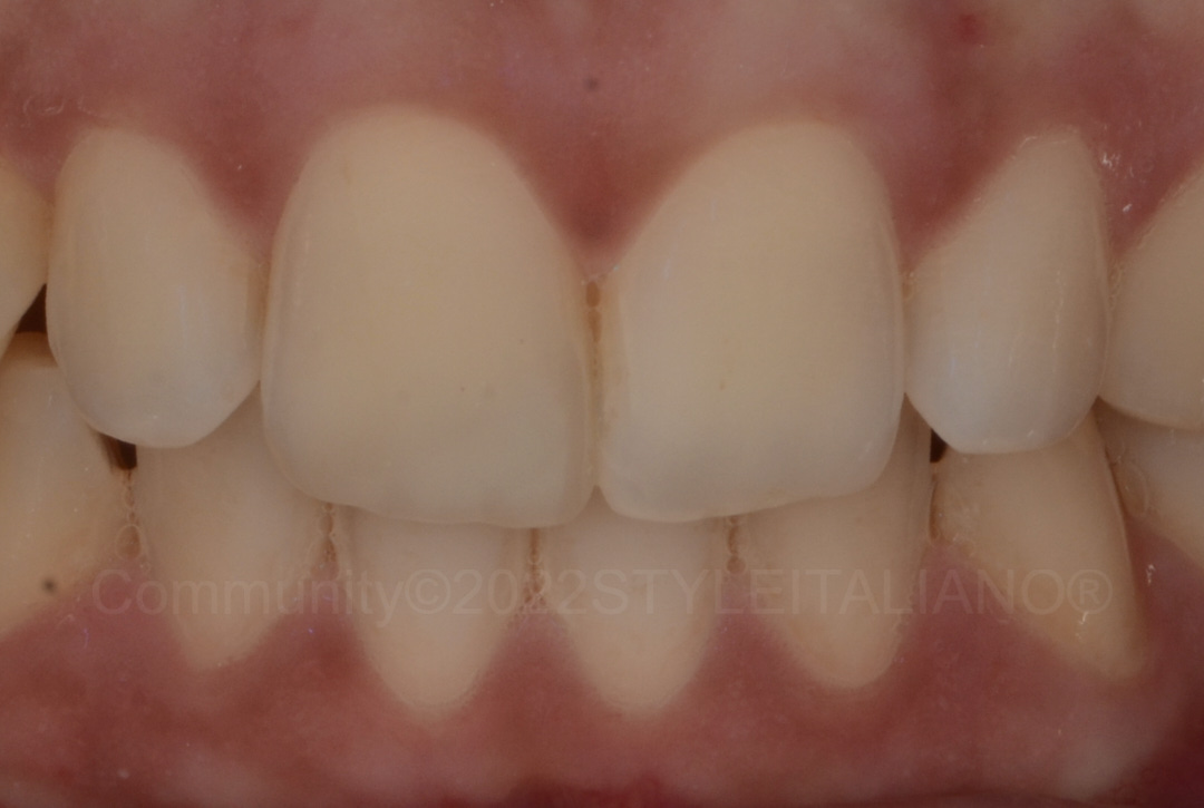 styleitaliano style italiano mobile dental polarized photograph of composite restoration