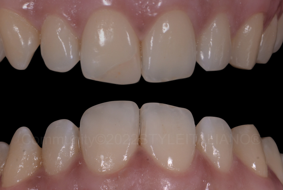 styleitaliano style italiano before and after restoration of central incisor