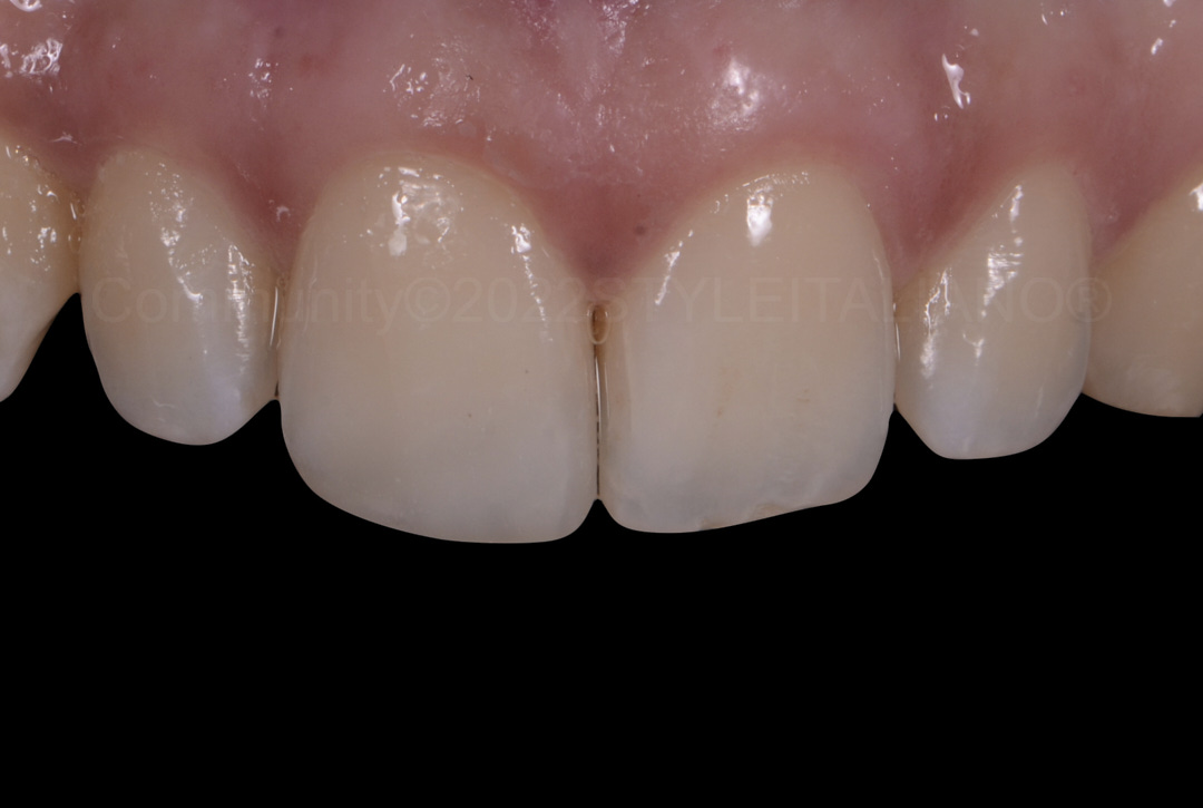 styleitaliano style italiano seamless restored central incisor